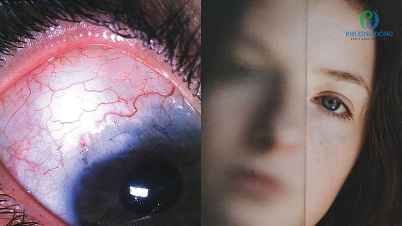 Nguyên nhân dẫn đến tăng nhãn áp góc mở nguyên phát