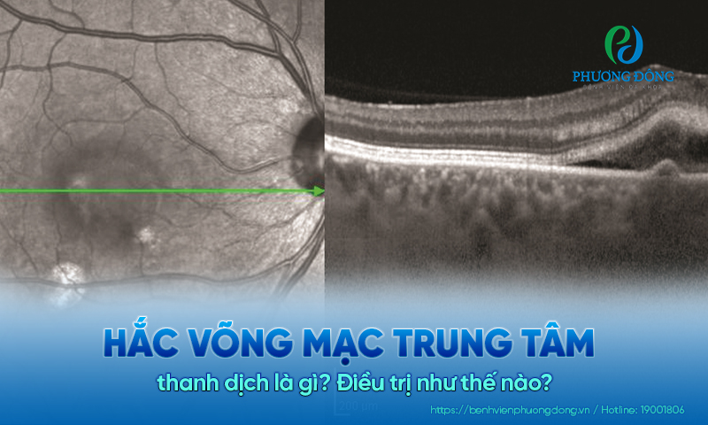 Hắc võng mạc trung tâm thanh dịch là gì? Điều trị như thế nào?