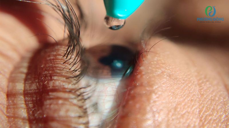 Mắt không thể tự giảm độ cận thông qua các biện pháp chăm sóc đơn giản tại nhà