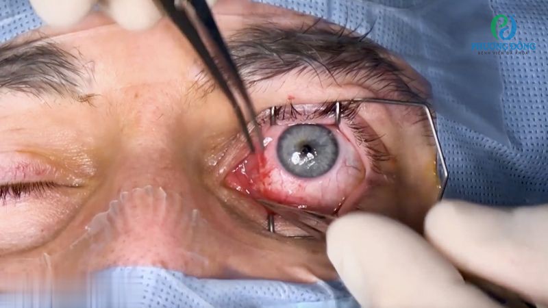 Hỏi đáp chuyên khoa Mắt: Mổ mắt lác có nguy hiểm không?