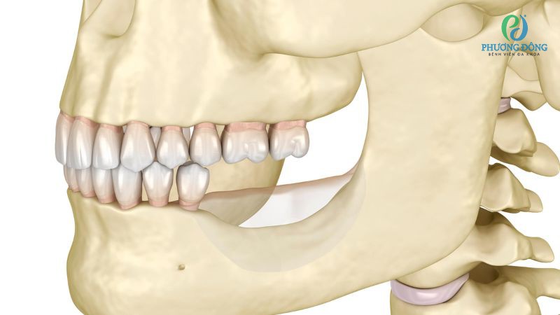Tiêu xương răng giai đoạn sớm có thể điều trị, can thiệp phục hồi chức năng đã mất