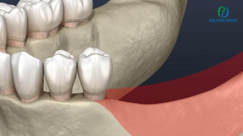 Hỏi đáp chuyên khoa Răng - Hàm - Mặt: Tiêu xương răng có chữa được không?