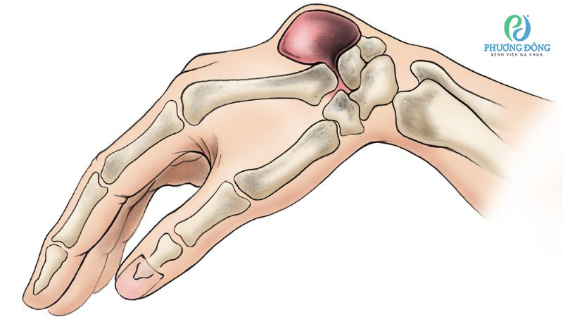 Đa phần các u nang hoạt dịch cổ tay không gây nguy hiểm đến chức năng vận động