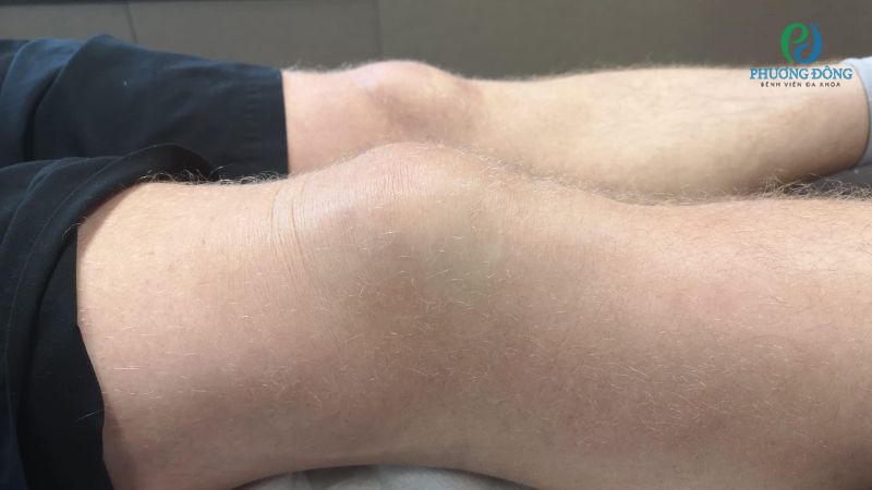 Viêm bao hoạt dịch khớp sẽ được dùng thuốc kháng sinh, kháng viêm theo tình trạng thực tế