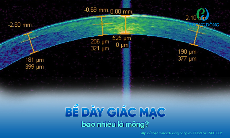 Giải đáp nhãn khoa: Bề dày giác mạc bao nhiêu là mỏng?