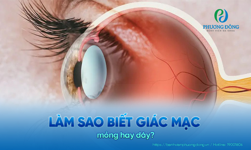 Làm sao biết giác mạc mỏng hay dày? Có tự đo ở nhà được không?
