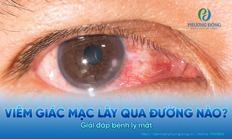 Giải đáp bệnh lý mắt: Viêm giác mạc lây qua đường nào?