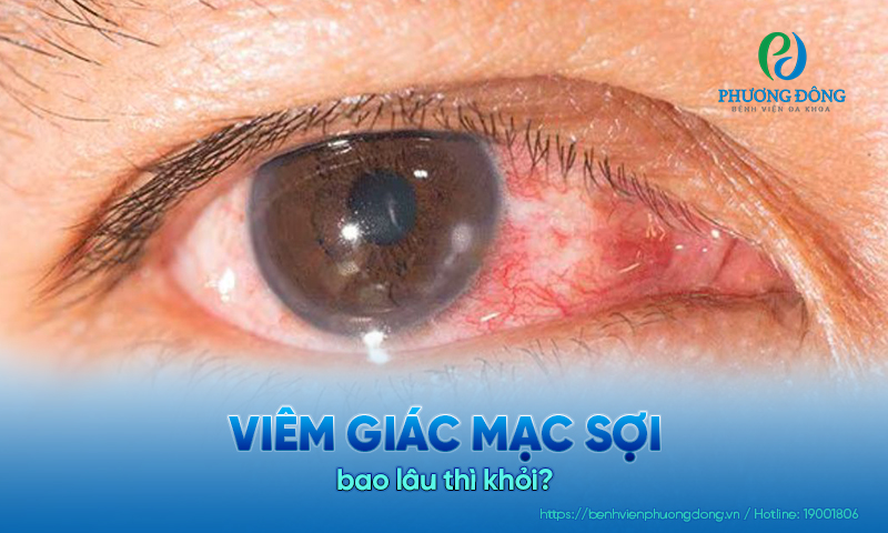 Giải đáp cho bệnh nhân: Viêm giác mạc sợi bao lâu thì khỏi?