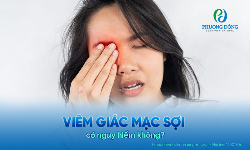 Giải đáp nhãn khoa: Viêm giác mạc sợi có nguy hiểm không?