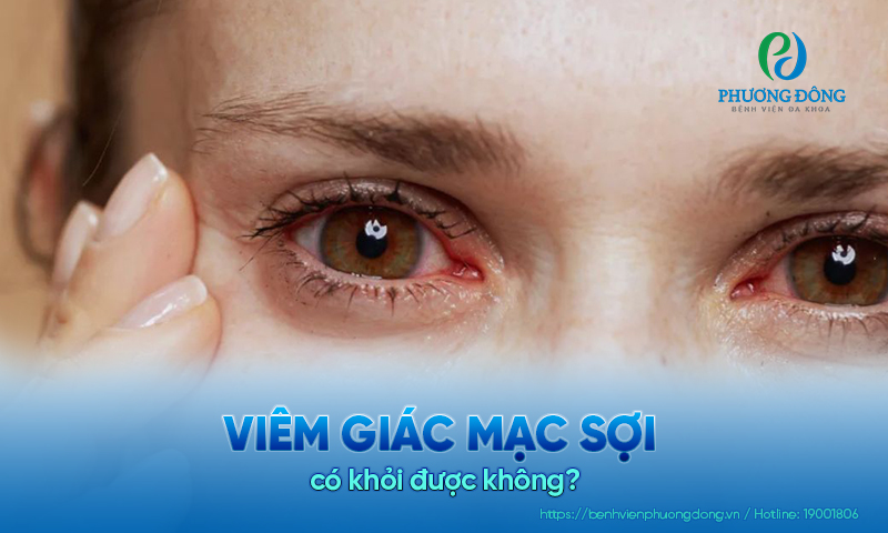 Bác sĩ chuyên khoa Mắt trả lời: Viêm giác mạc sợi có khỏi được không?