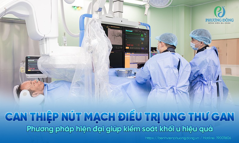 Can thiệp nút mạch điều trị ung thư gan: Phương pháp hiện đại giúp kiểm soát khối u hiệu quả