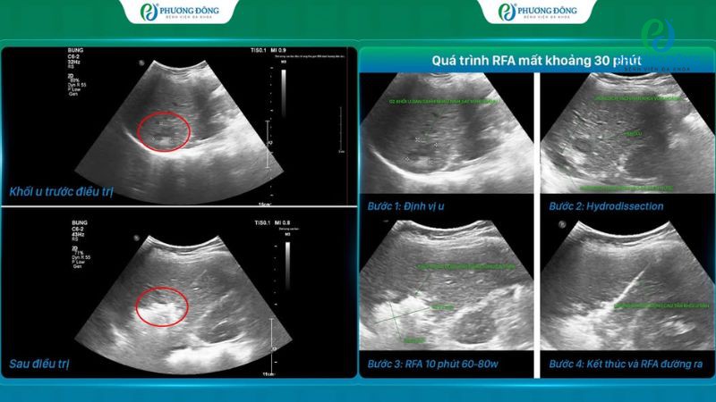 Hệ thống CT Photon NAEOTOM Alpha hỗ trợ chẩn đoán, theo dõi tiến triển khối u trước và sau điều trị