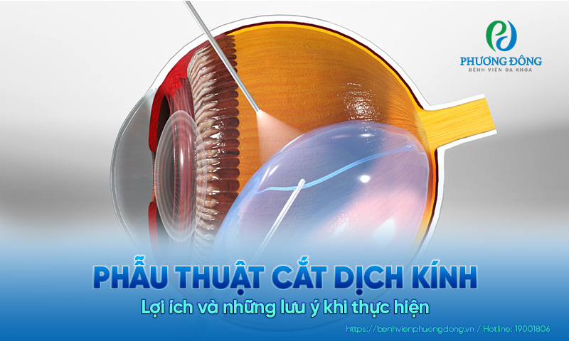 Phẫu thuật cắt dịch kính: Lợi ích và những lưu ý khi thực hiện 