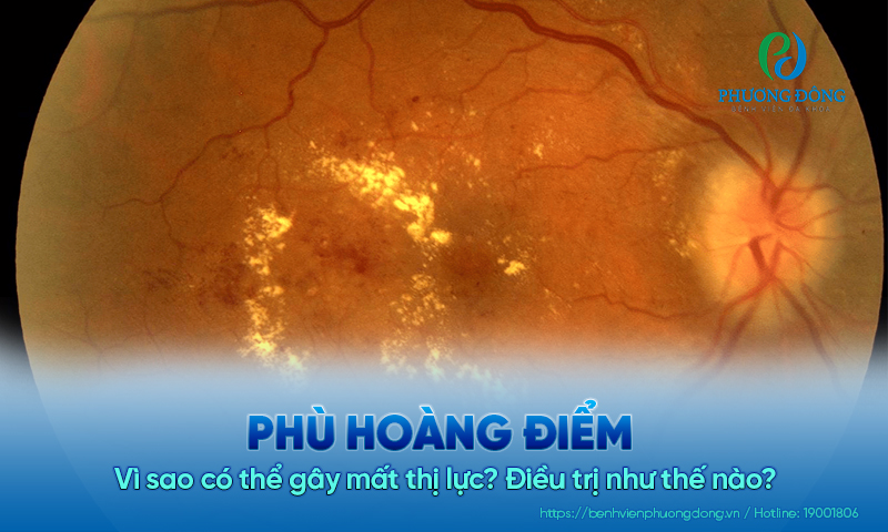 Phù hoàng điểm: Vì sao có thể gây mất thị lực? Điều trị như thế nào?