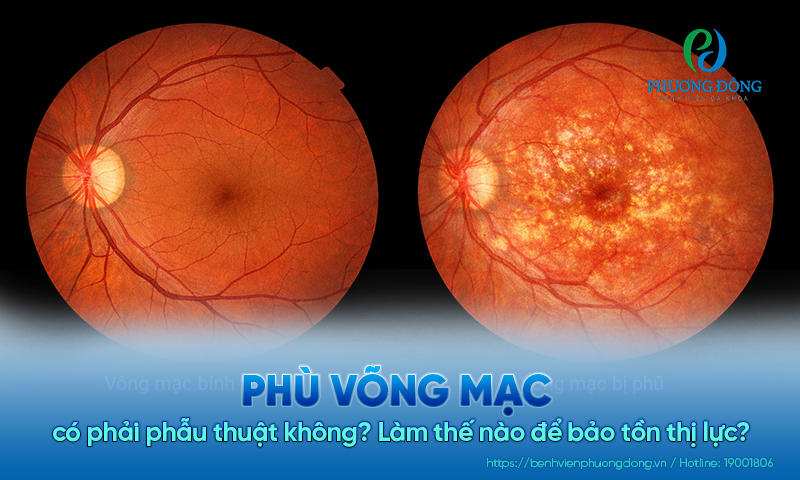 Phù võng mạc có phải phẫu thuật không? Làm thế nào để bảo tồn thị lực?