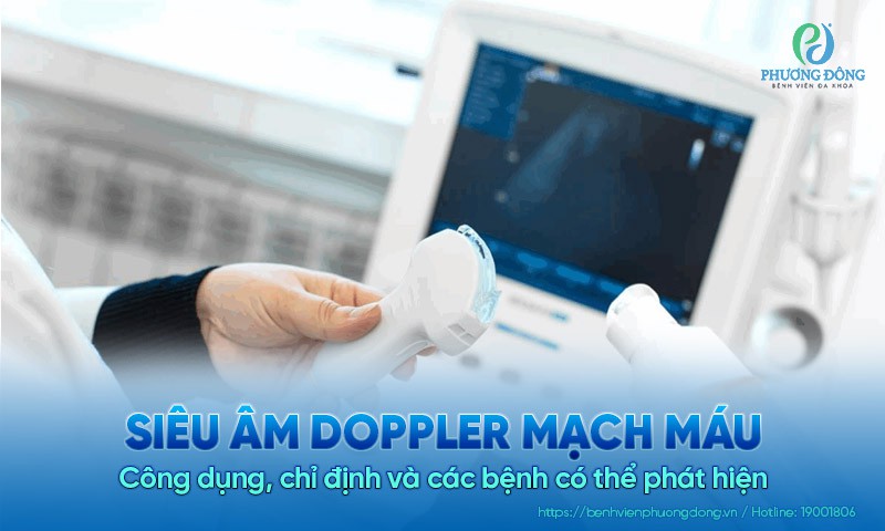 Siêu âm Doppler mạch máu là gì? Công dụng, chỉ định và các bệnh có thể phát hiện