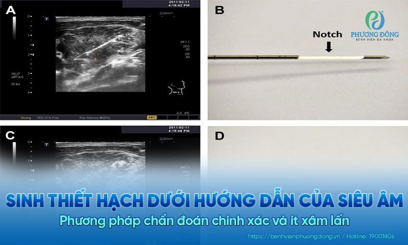 Sinh thiết hạch dưới hướng dẫn siêu âm – phương pháp chẩn đoán chính xác và ít xâm lấn