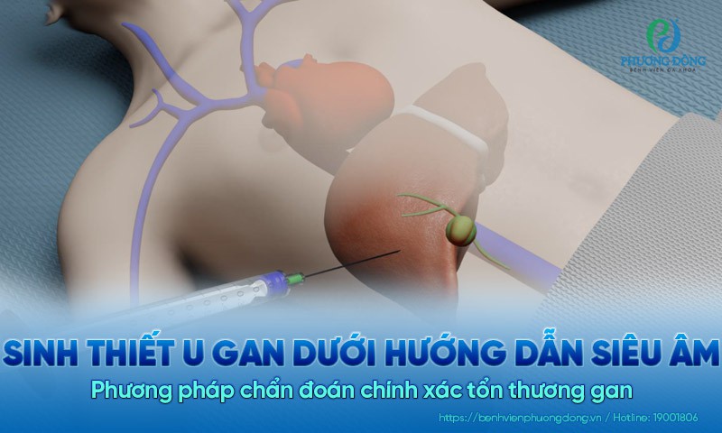 Sinh thiết u gan dưới hướng dẫn siêu âm: Phương pháp chẩn đoán chính xác tổn thương gan