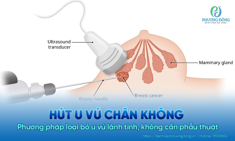 Sinh thiết u vú có hỗ trợ thiết bị hút chân không: Phương pháp loại bỏ u vú lành tính ít xâm lấn, không cần phẫu thuật