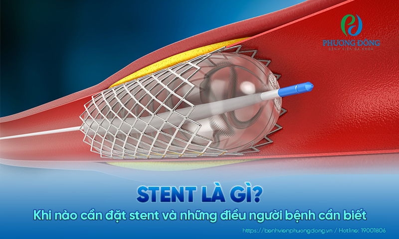 Stent là gì? Khi nào cần đặt stent và những điều người bệnh cần biết 
