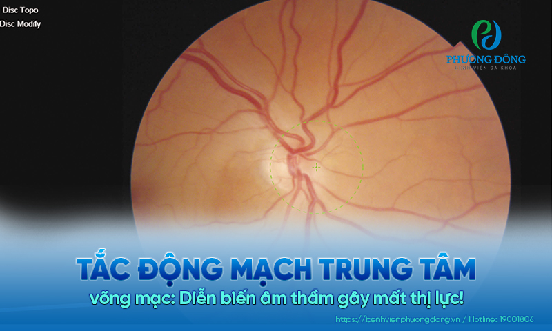 Tắc động mạch trung tâm võng mạc: Diễn biến âm thầm gây mất thị lực!