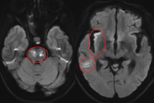 Tắc mạch não là gì? Vai trò của chẩn đoán hình ảnh trong chẩn đoán và sàng lọc?