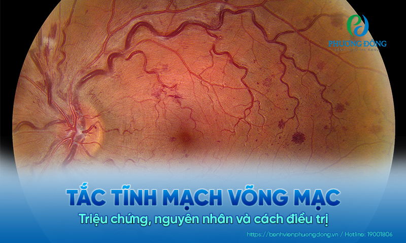 Tắc tĩnh mạch võng mạc: Triệu chứng, nguyên nhân và cách điều trị 