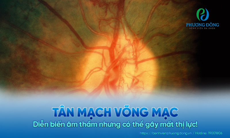 Tân mạch võng mạc diễn biến âm thầm nhưng có thể gây mất thị lực!