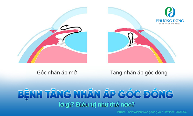  Bệnh tăng nhãn áp góc đóng là gì? Điều trị như thế nào?