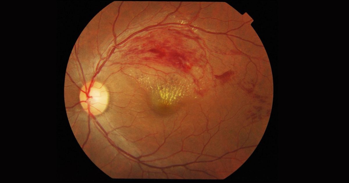 Người có bất thường tắc mạch máu võng mạc có nguy cơ mắc tăng nhãn áp cao hơn