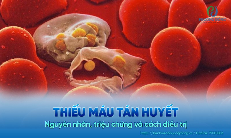 Thiếu máu tán huyết: Nguyên nhân, triệu chứng và cách điều trị