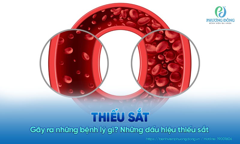 Thiếu sắt gây ra những bệnh lý gì? Những dấu hiệu thiếu sắt mà bạn nên biết