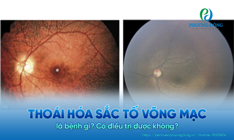 Thoái hóa sắc tố võng mạc là bệnh gì? Có điều trị được không?