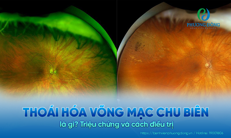 Thoái hóa võng mạc chu biên là gì? Triệu chứng và cách điều trị 