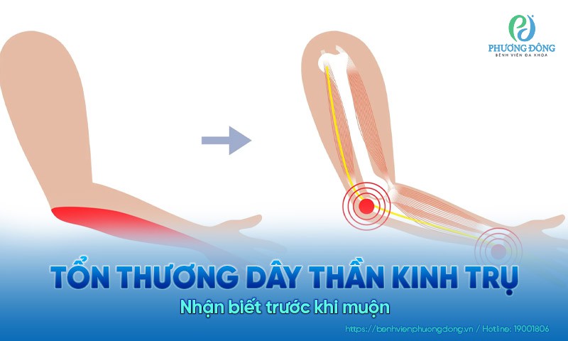 Tổn thương dây thần kinh trụ: Nhận biết trước khi muộn