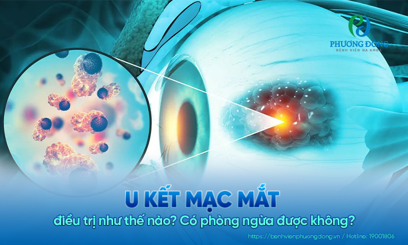 U kết mạc mắt điều trị như thế nào? Có phòng ngừa được không?