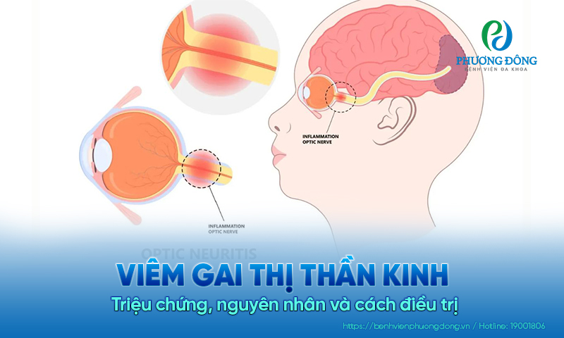 Viêm gai thị thần kinh: Triệu chứng, nguyên nhân và cách điều trị 