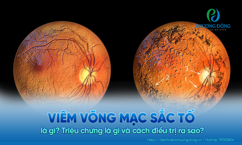 Bệnh viêm võng mạc sắc tố là gì? Triệu chứng là gì và cách điều trị ra sao?