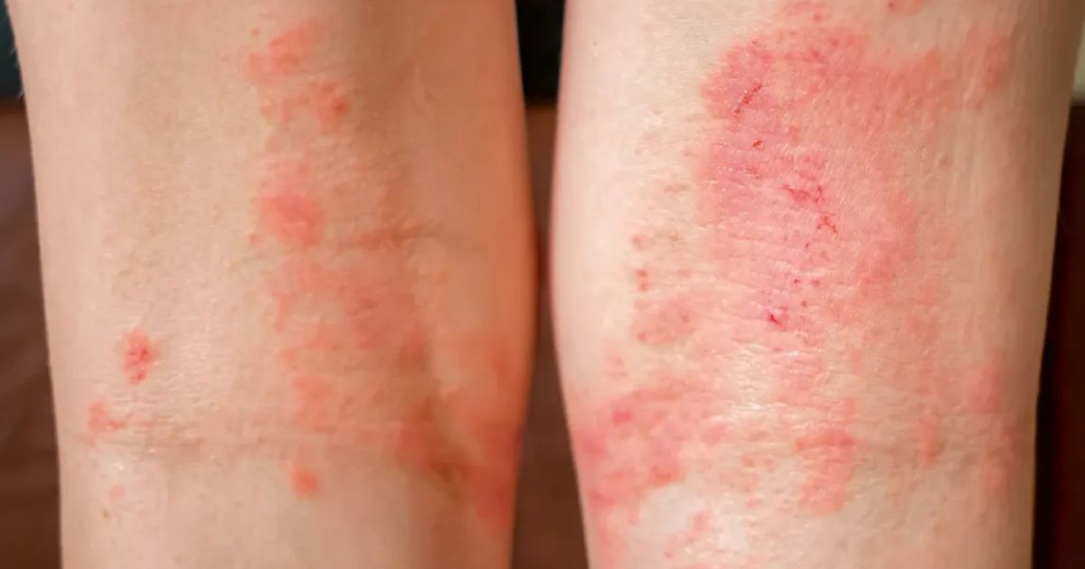 Sau khi điều trị, người bệnh có thể bị viêm da