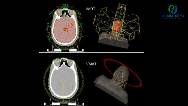 Cách thức hoạt động của VMAT và IMRT trong điều trị ung thư