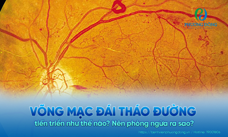 Võng mạc đái tháo đường tiến triển như thế nào? Nên phòng ngừa ra sao?