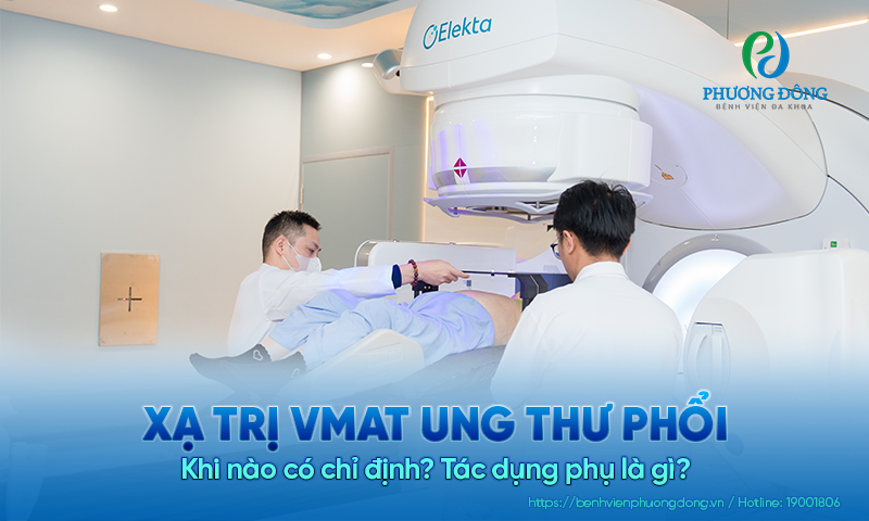 Xạ trị VMAT ung thư phổi: Khi nào có chỉ định? Tác dụng phụ là gì?
