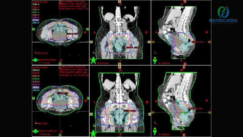 VMAT thường được chỉ định ở giai đoạn tiền phẫu, hậu phẫu hoặc ở bệnh nhân tái phát ung thư trực tràng