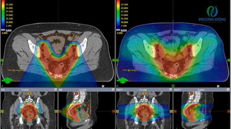 VMAT nổi bật với mức độ độc tính thấp, rất ít bệnh nhân bị viêm ruột hoặc tiêu chảy