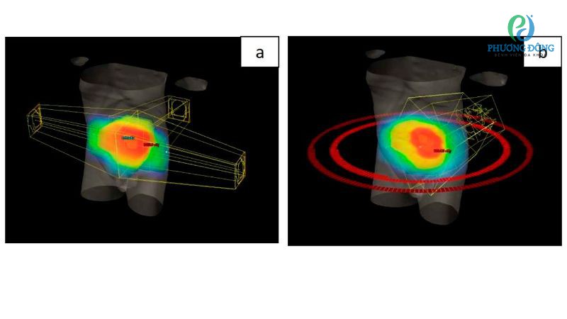 VMAT thường được chỉ định ở giai đoạn tiền phẫu, hậu phẫu hoặc ở bệnh nhân tái phát ung thư trực tràng
