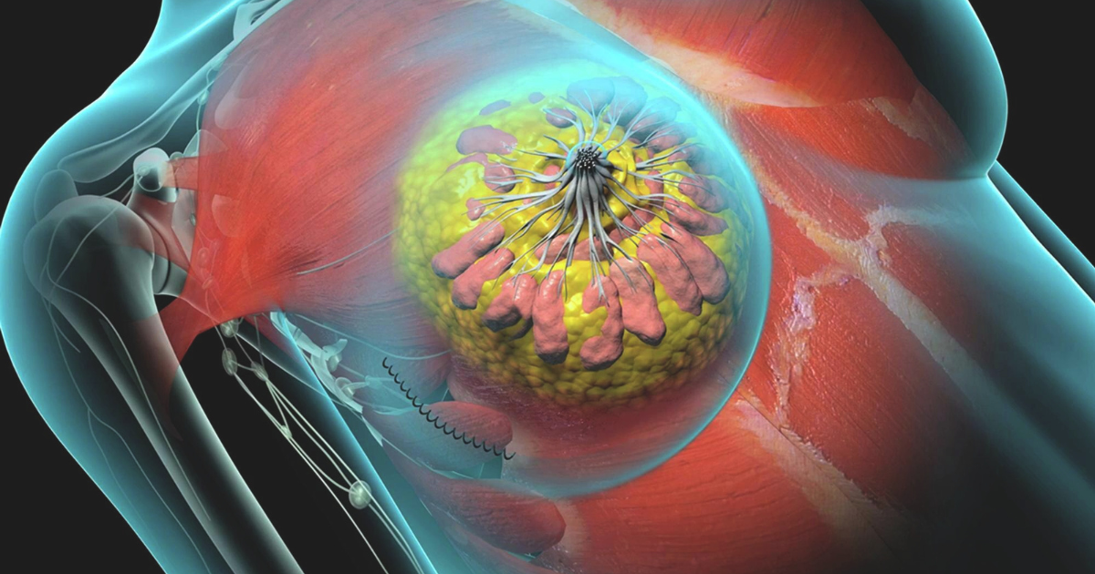 Xạ trị có thể được chỉ định cho các ca bệnh sau khi cắt bỏ toàn bộ vú do khối u lớn