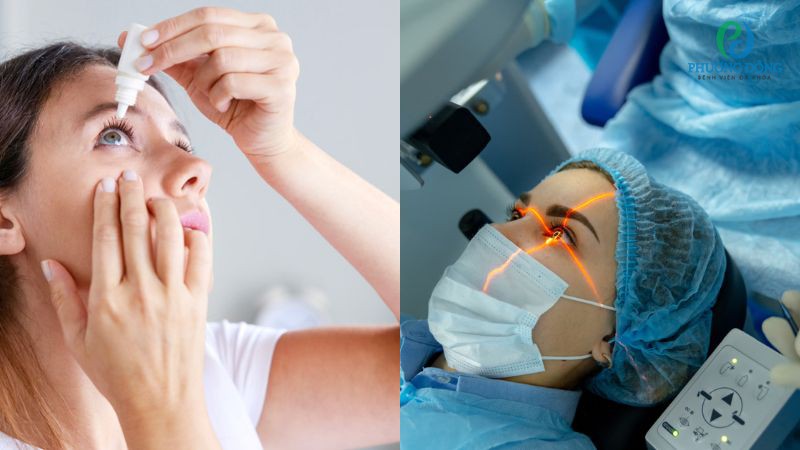 Đa số trường hợp bị viêm giác mạc chỉ cần điều trị nội khoa với thuốc nhỏ mắt