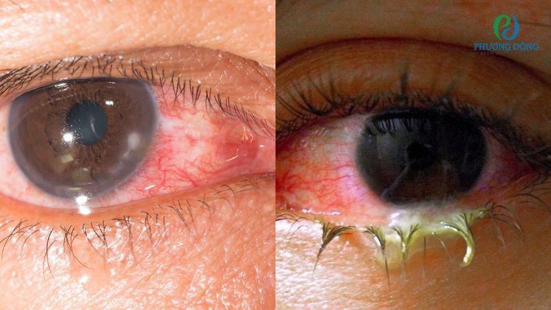 Phân biệt viêm giác mạc và đau mắt đỏ về vị trí tổn thương, triệu chứng và mức độ nguy hiểm
