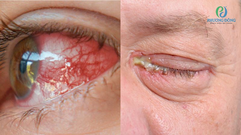 Hỏi đáp chuyên khoa Mắt: Viêm giác mạc có phải là đau mắt đỏ không?