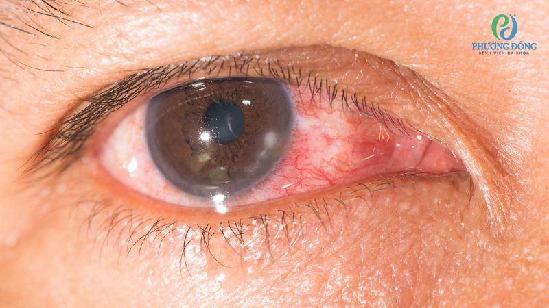 Trung bình viêm giác mạc nhẹ cần điều trị ổn định trong khoảng 10 ngày